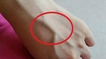 有人手臂上“青筋暴起”，有人卻看不到“青筋”，這是咋回事？